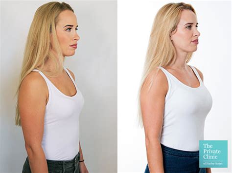 fake breast implants clothes try on haul - Breast Augmentation: Before and After Photos That Wow.